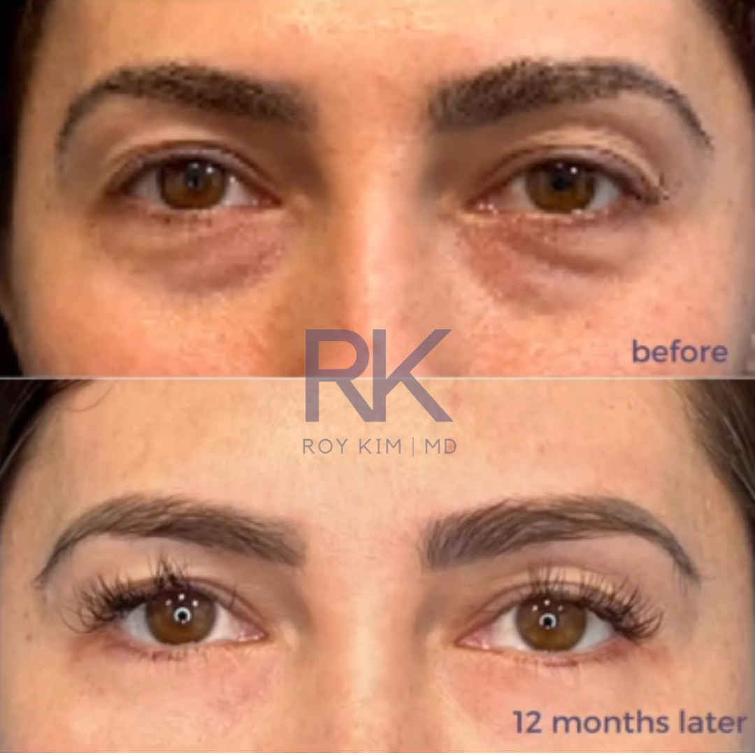 Discover the Secret to a Youthful Look with Lower Blepharoplasty