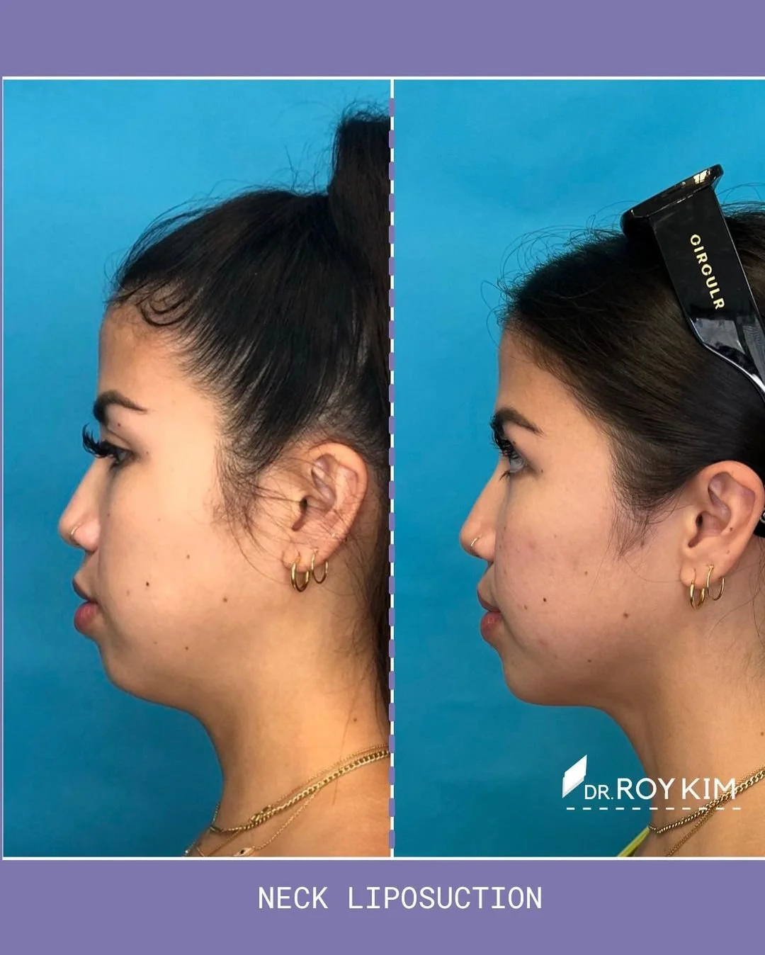 Considering Neck Liposuction?