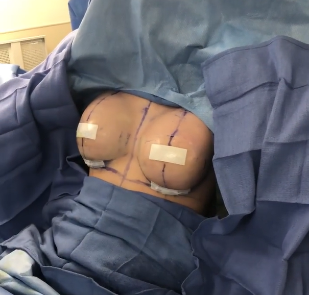 The "Perfect Pocket" Technique in Breast Augmentation