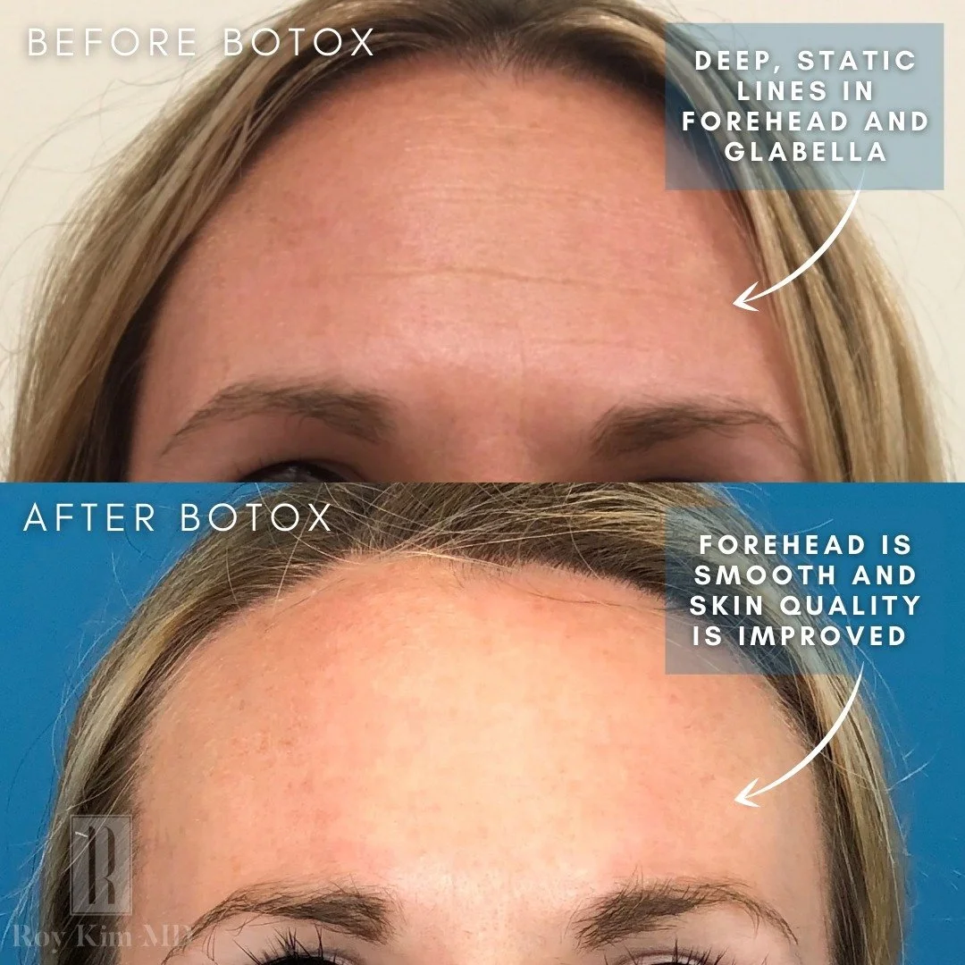 The Secret to Smooth and Youthful Skin: Neurotoxin