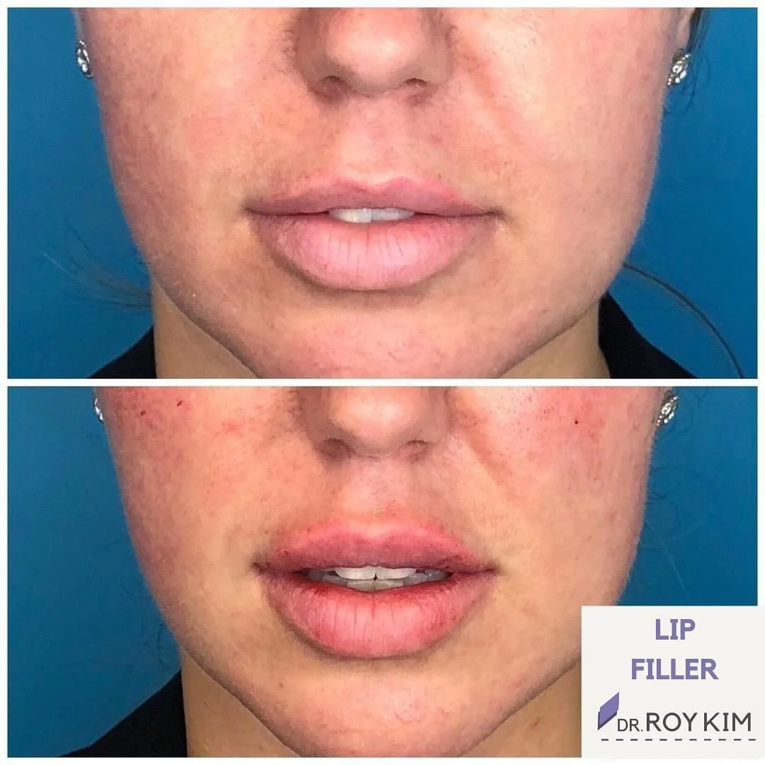 Refining Beauty: The Delicate Approach to Lip Enhancement