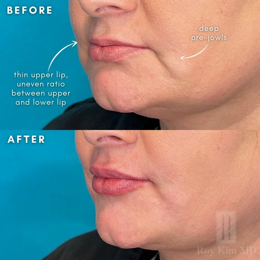 Lip Filler: More Than Just Plumping Lips