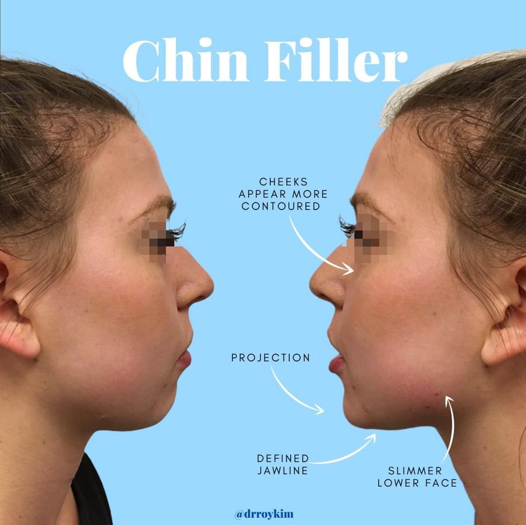 The Domino Effect of Dermal Fillers