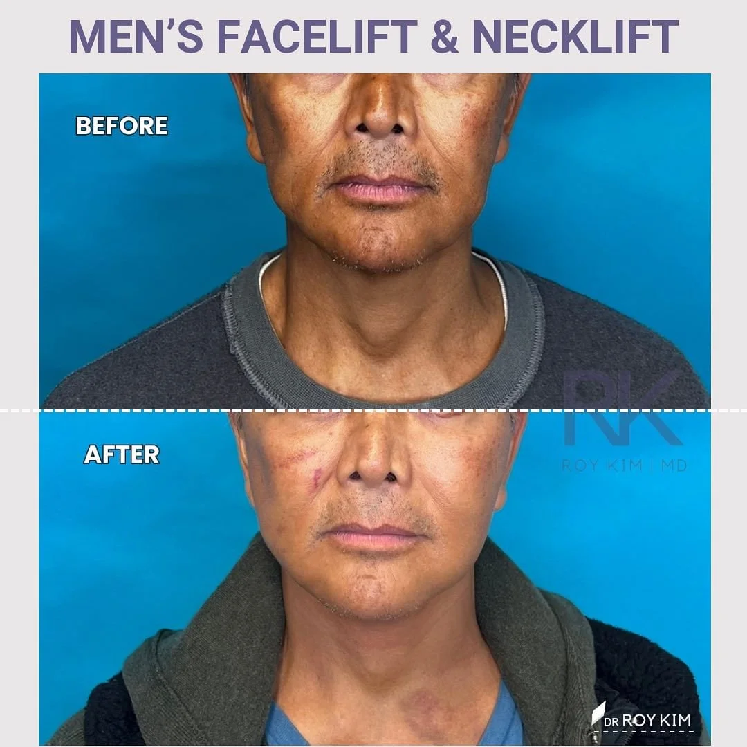 Mastering Masculine Aesthetics: Facelifts and Necklifts for Men
