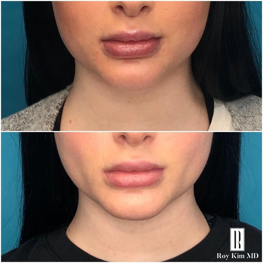 The Transformative Power of Chin Liposuction
