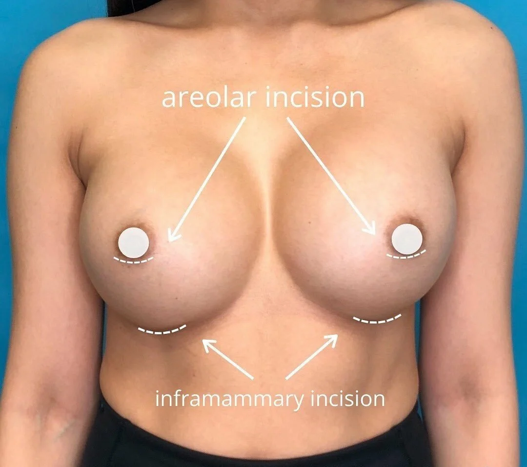 Which Breast Implant Incision is Best For You?