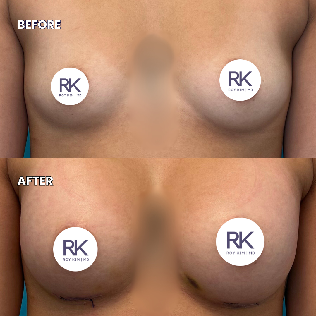 Breast Augmentation to Achieve Proportional Beauty with 350 cc Moderate Plus Implants