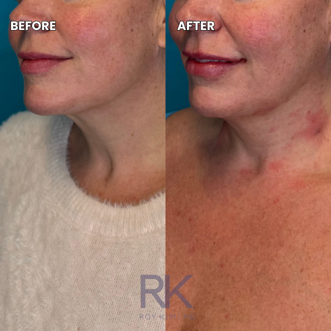 The Art of Refinement: Lip Enhancement Meets Neck Rejuvenation