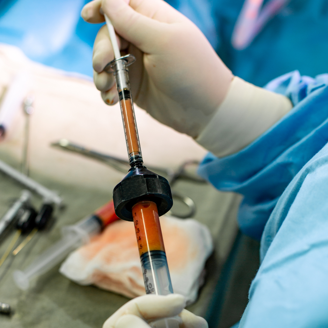 Exploring Fat Grafting: Macro Fat/Regular Fat, Micro Fat, and Nano Fat