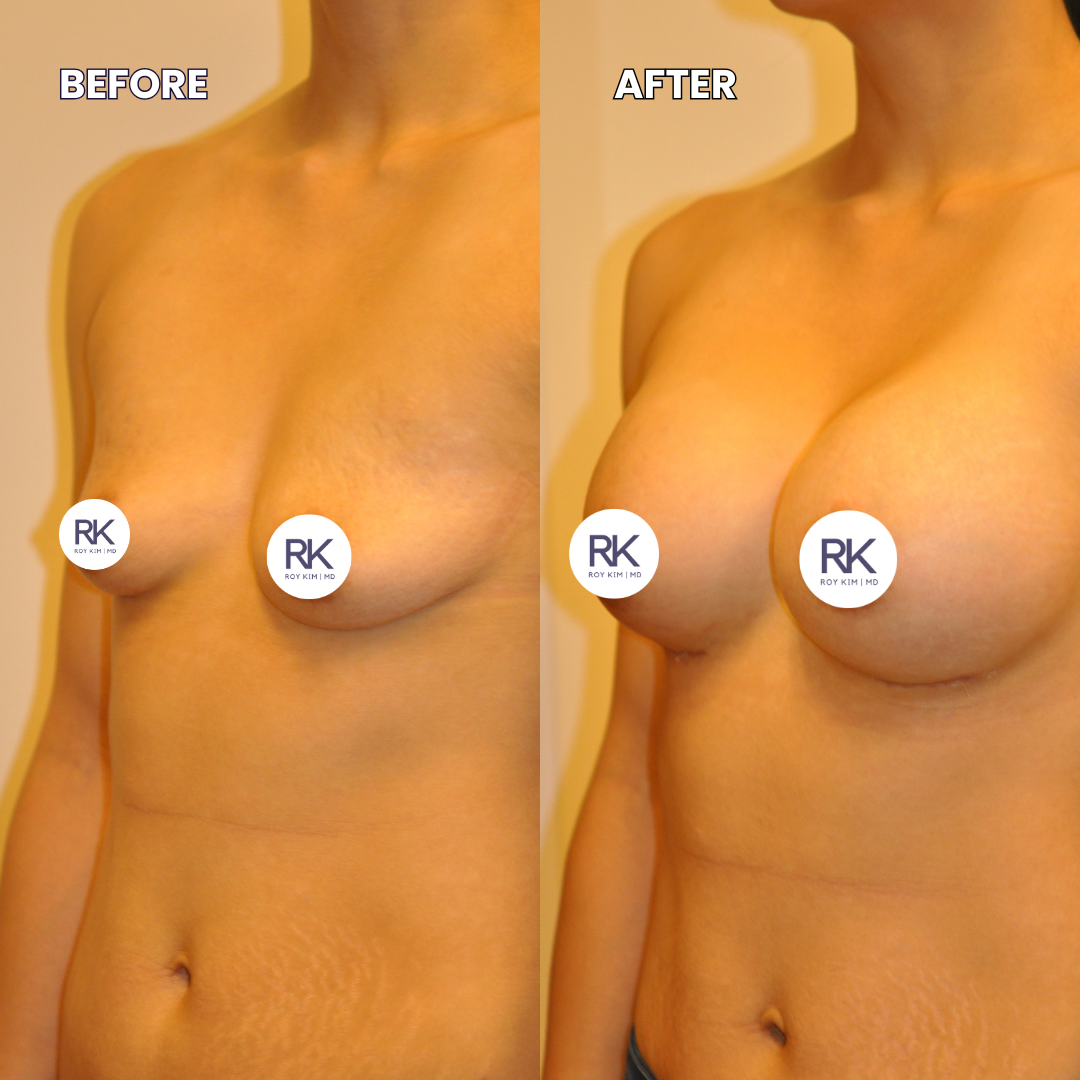 Transformative Results with Breast Augmentation: Before & After