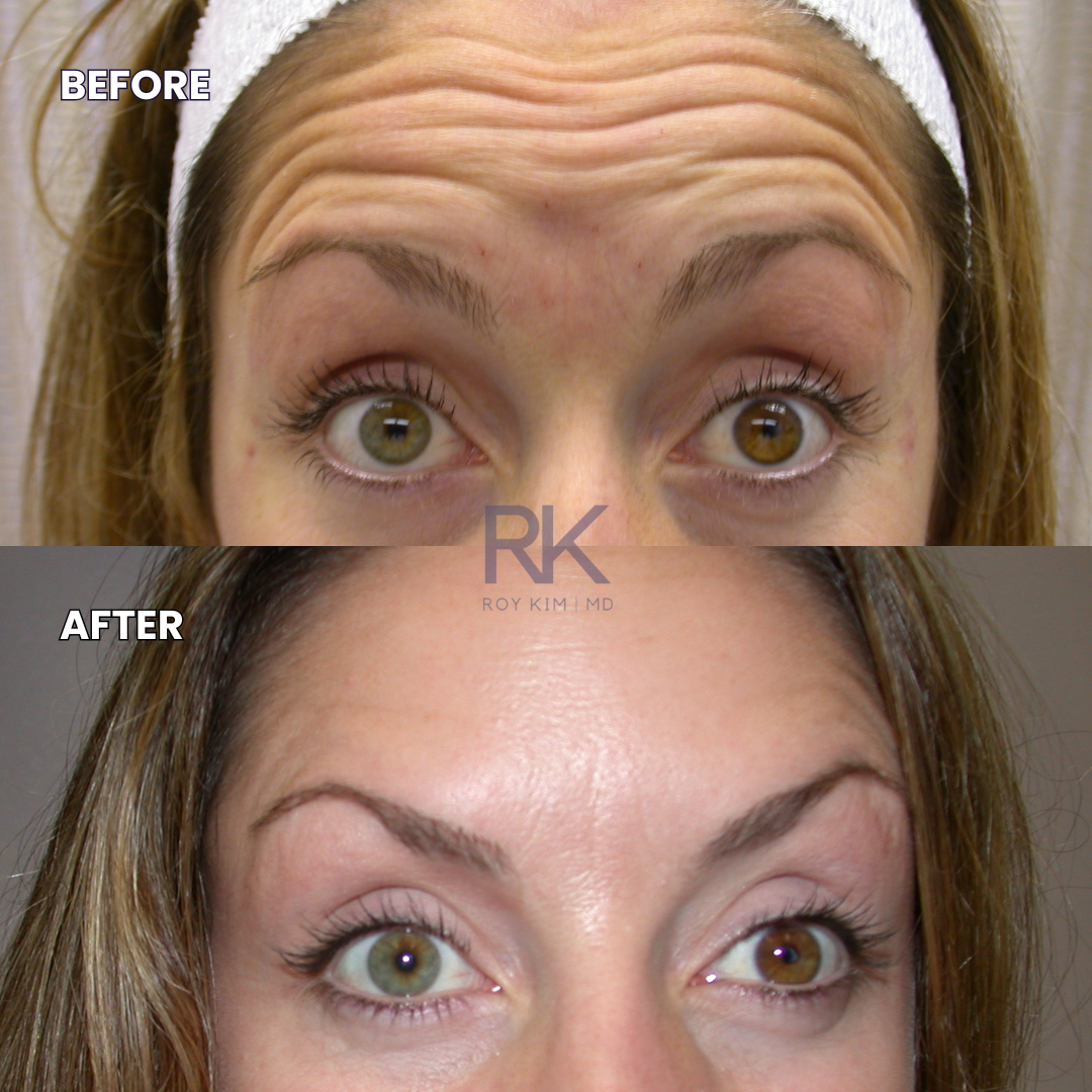 Before and After Botox: Transform Your Forehead & Glabella Lines