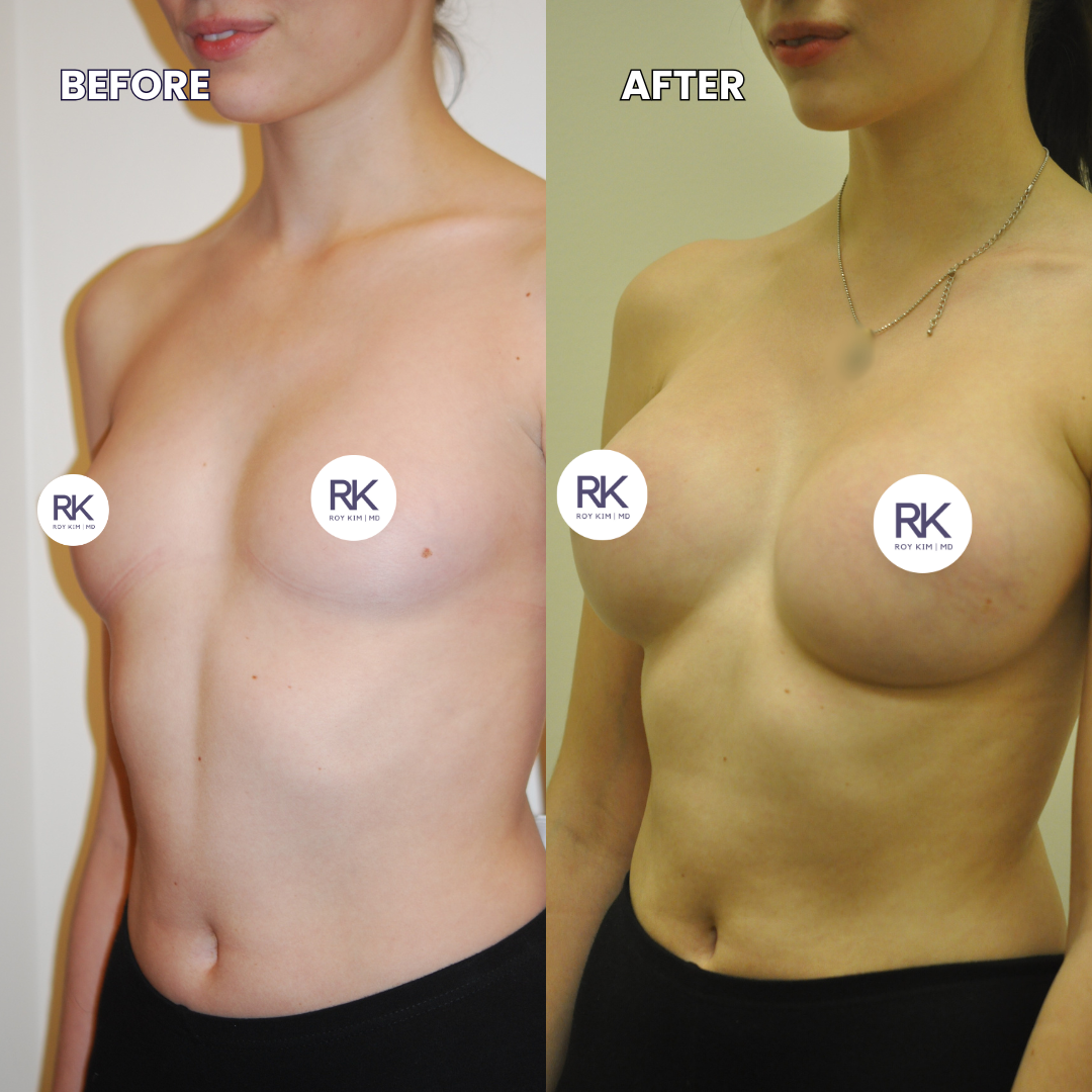 Breast Augmentation Before and After: Achieving Natural Results with 390cc Implants