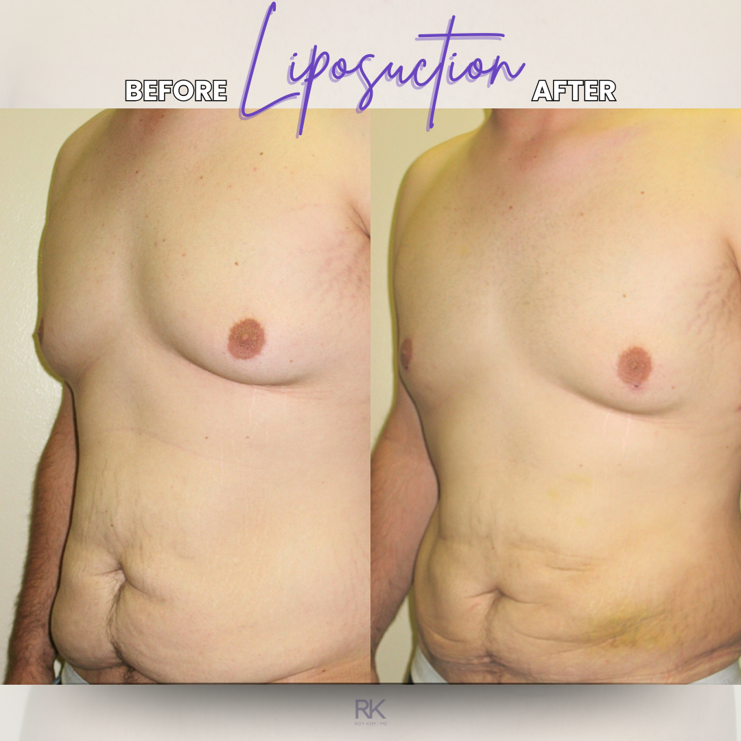 Vaser Liposuction Transformation: Post Weight Loss Body Contouring Success
