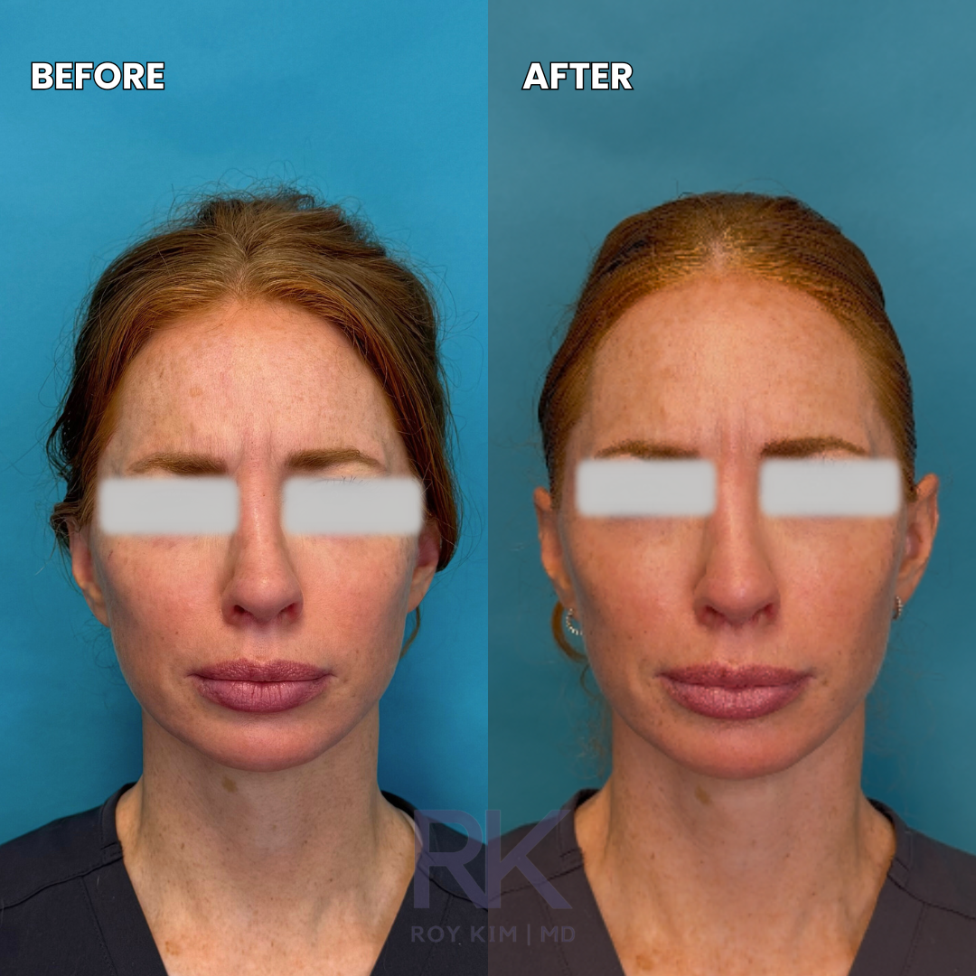 Before and after images of a woman's face showing cosmetic improvements, with blue background, blurred eyes for privacy.