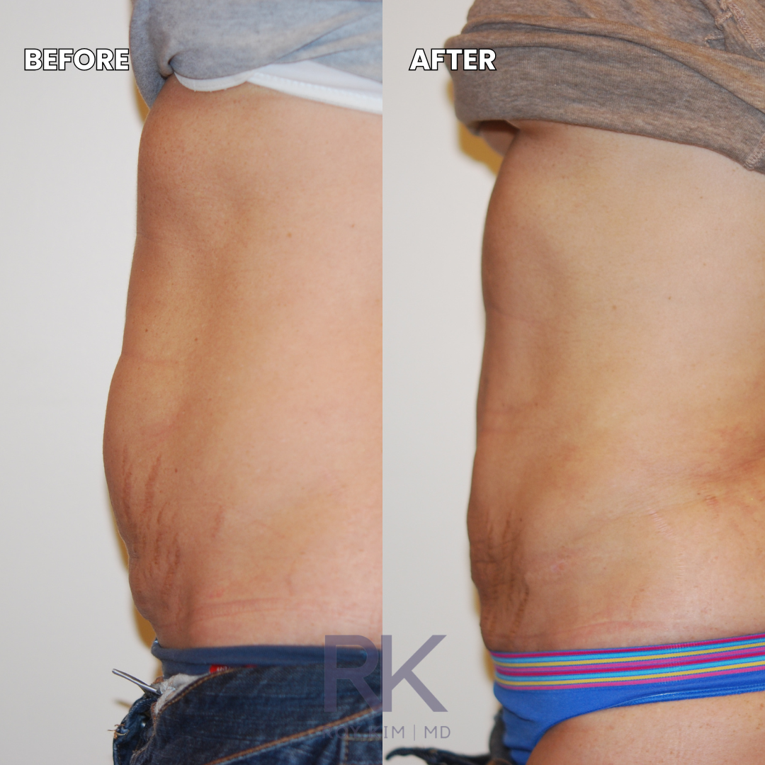 Comparison photo showing someone's abdominal area before and after a treatment or weight loss. The left side labeled 'BEFORE' shows loose skin and stretch marks, while the right side labeled 'AFTER' shows tighter skin with fewer visible stretch marks.