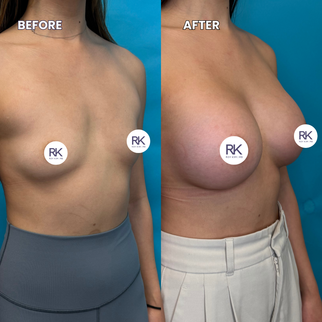 Side-by-side comparison of a woman's chest before and after breast augmentation surgery, with the left labeled 'BEFORE' showing smaller breasts and the right labeled 'AFTER' showing larger, fuller breasts, against a blue background.