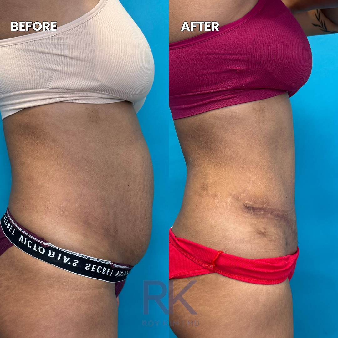 Comparison photo showing a woman's side torso before and after a body transformation, with the 'before' on the left and 'after' on the right, against a blue background.