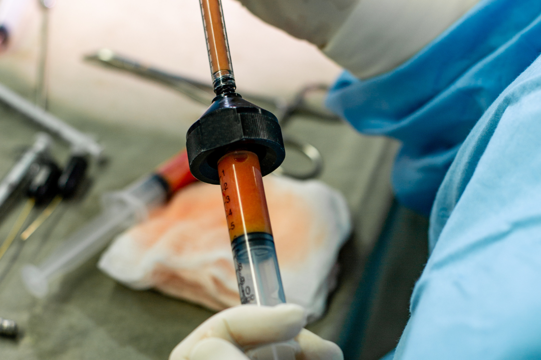 Does Creatine Help Fat Grafting Last Longer?