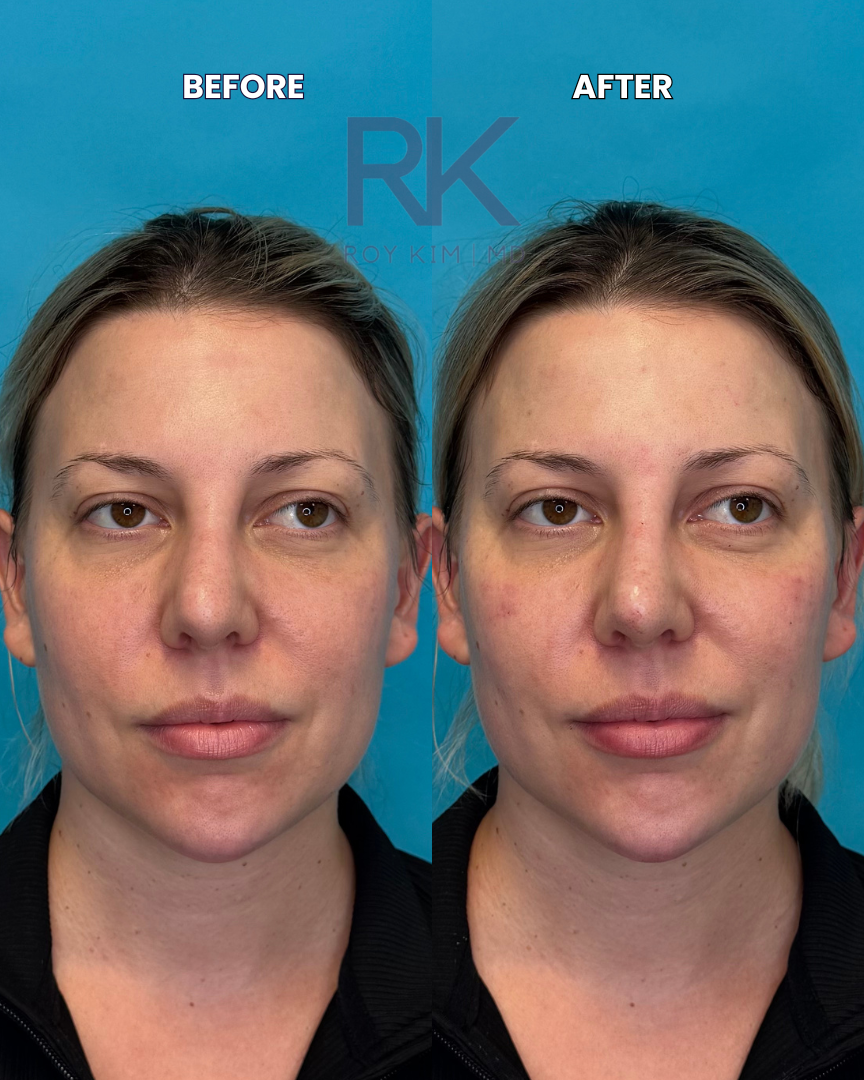 Side-by-side comparison of a woman's face labeled 'Before' and 'After' a skincare treatment, showing improved skin texture and tone.