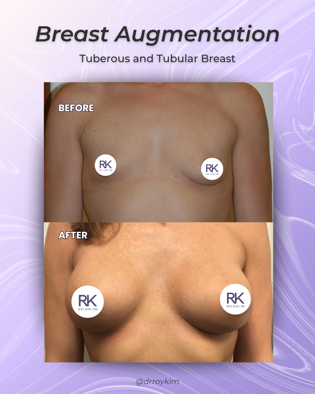 Tubular Breast Correction in San Francisco: What to Know Before Surgery