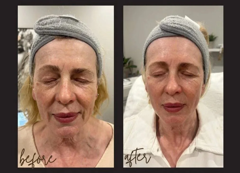 Side-by-side comparison of a woman's face before and after a skincare treatment. In the 'before' photo, her skin appears aged with wrinkles and uneven texture. In the 'after' photo, her skin looks smoother, more even, and rejuvenated.