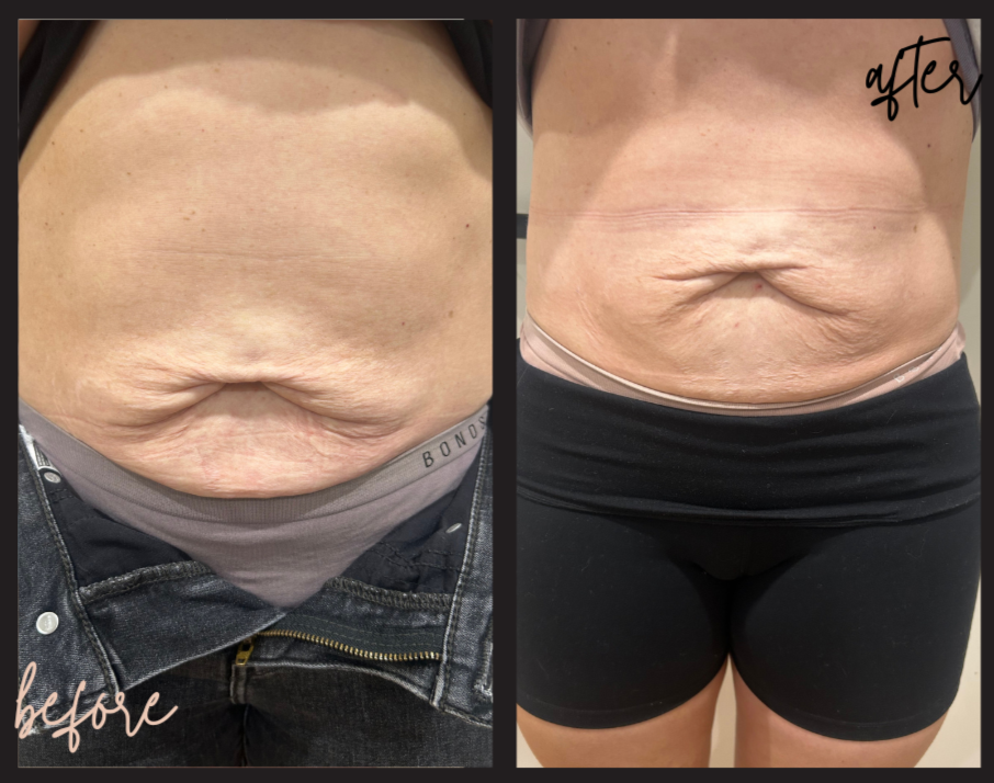 Body Contouring | Achieve Your Best Body Today — Meadows Skin and Beauty
