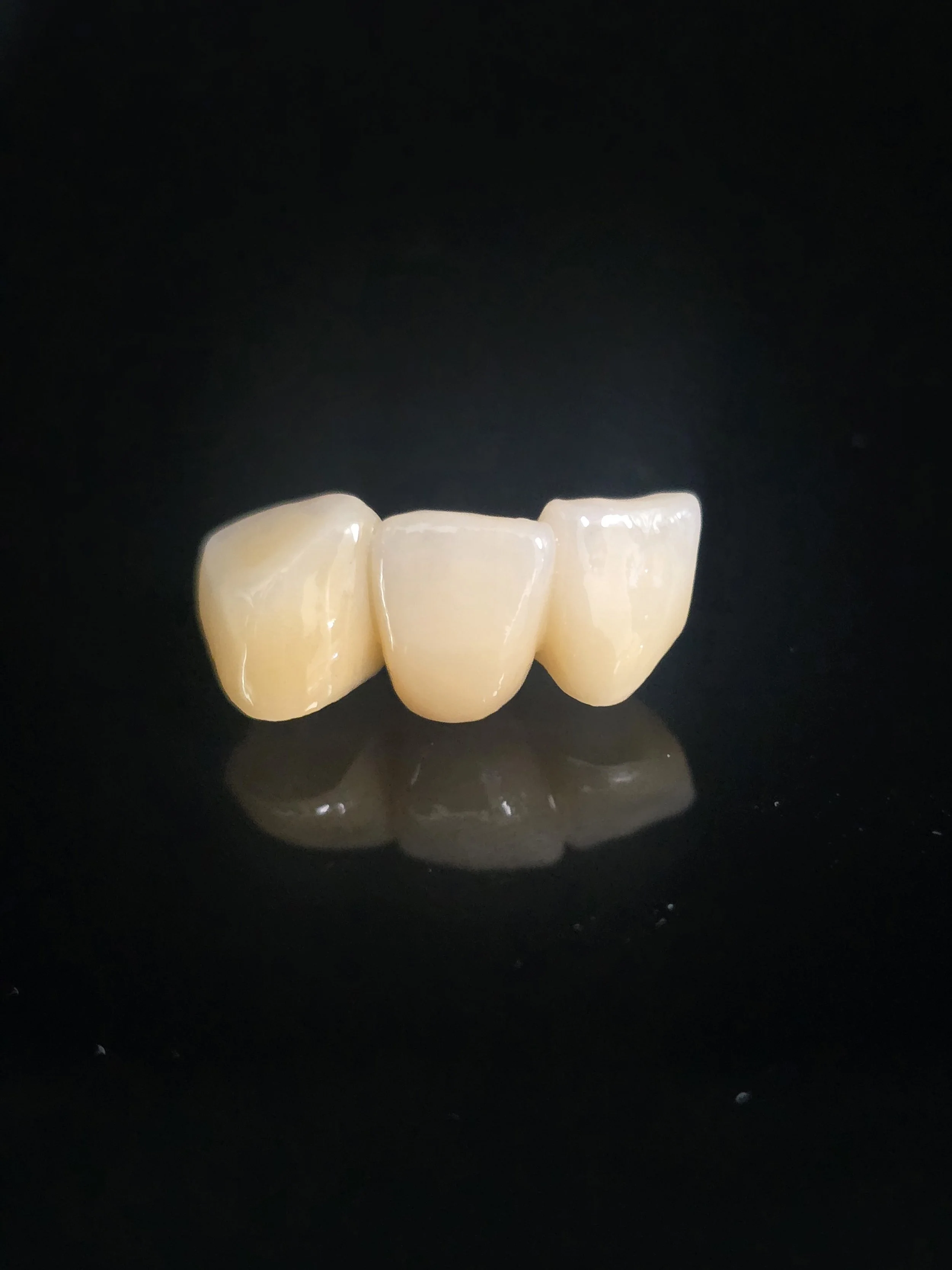 Anterior_3-Unit_Full_Contour_Zirconia_Bridge_2.jpg