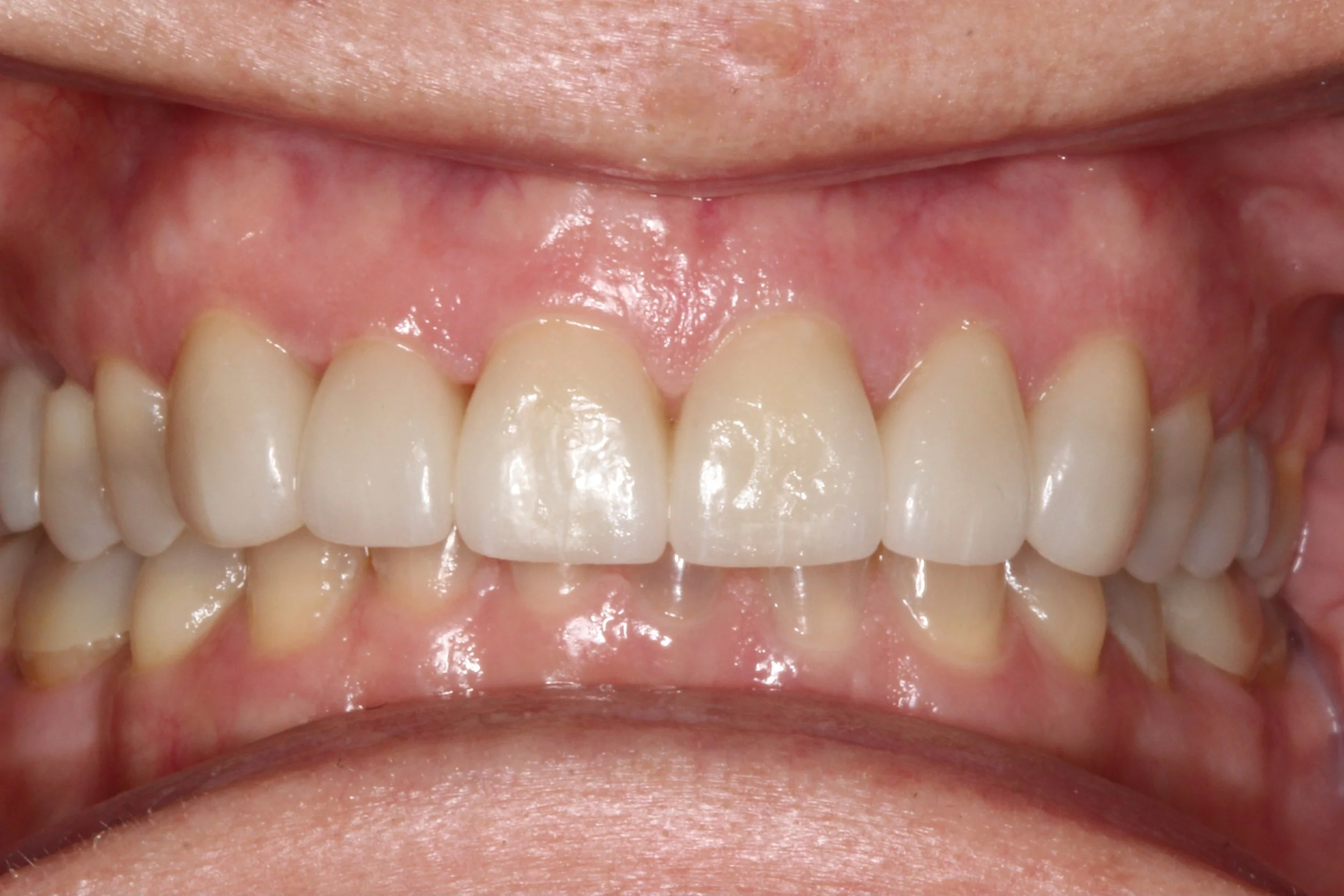 Full Contour e.Max Crown