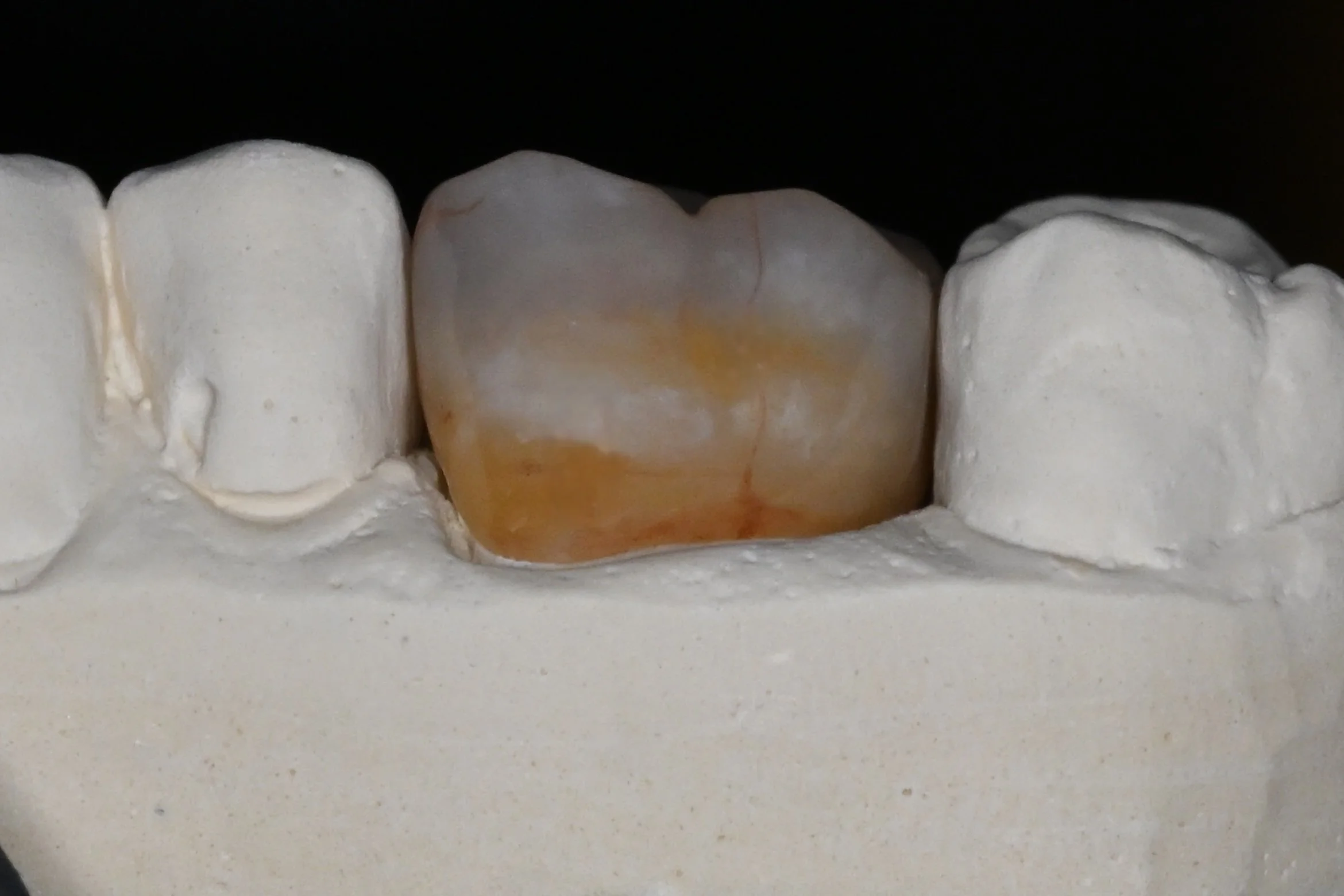 Posterior_Zirconia_Crown_With_Model_1.jpg