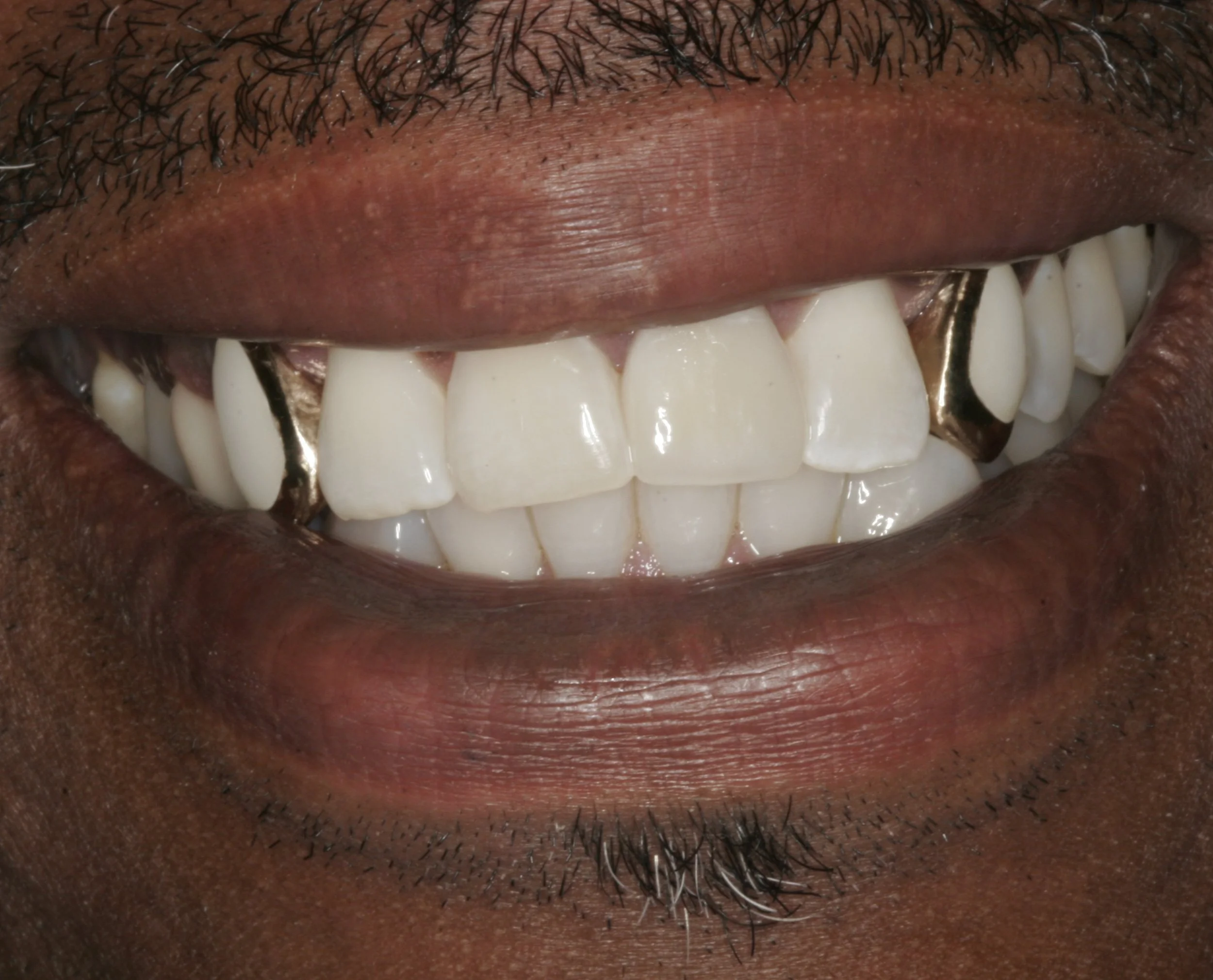 Gold_Window_Veneers_Front_View_2.jpg