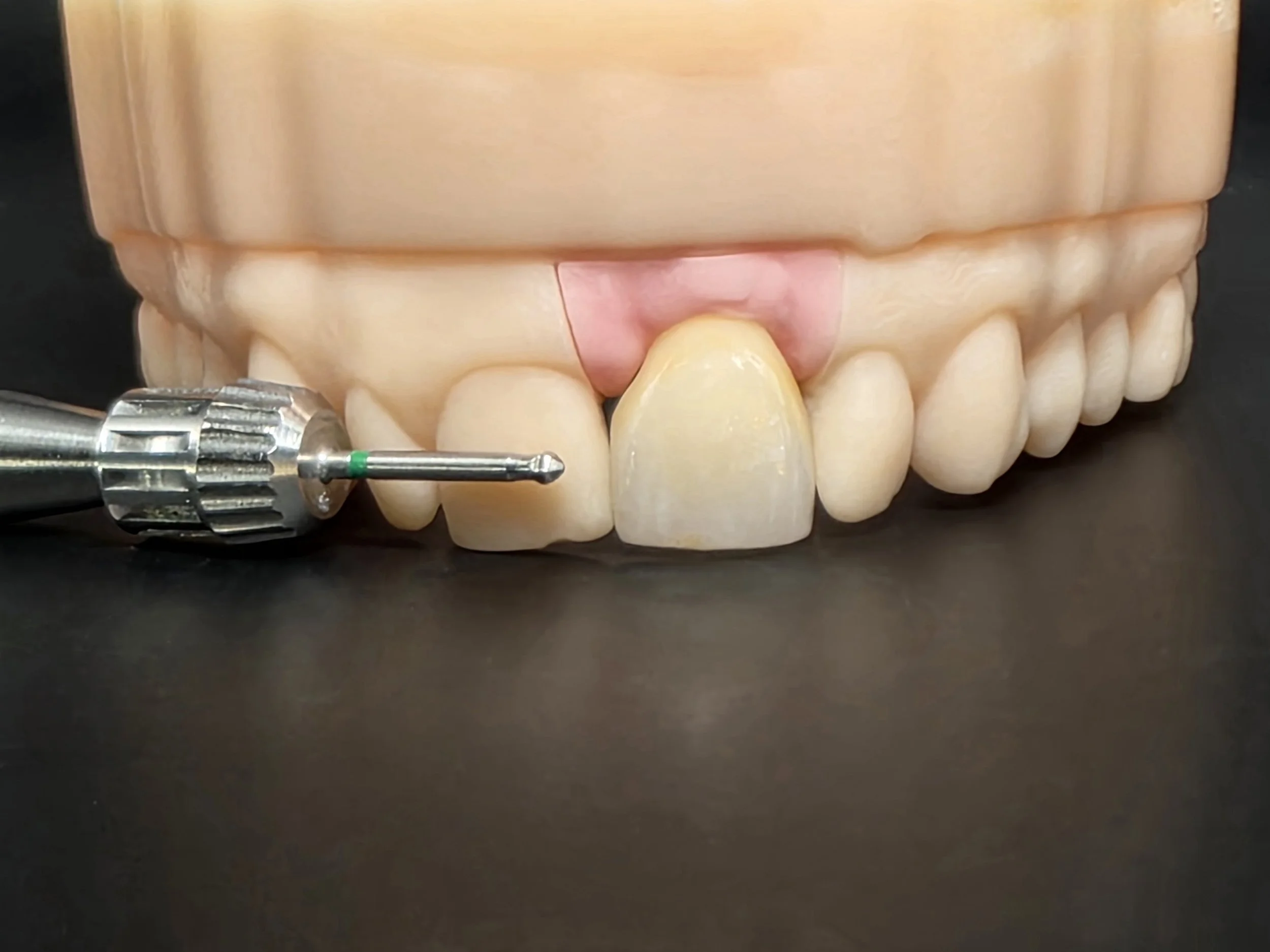 Custom Titanium Abutment Angled Screw Channel (A.S.C.) (Screw-Retained) Implant