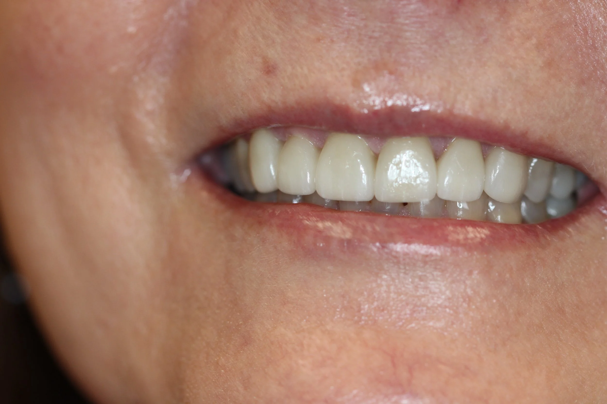 Anterior_Full_Coverage_e.Max_Natural_Smile.jpg