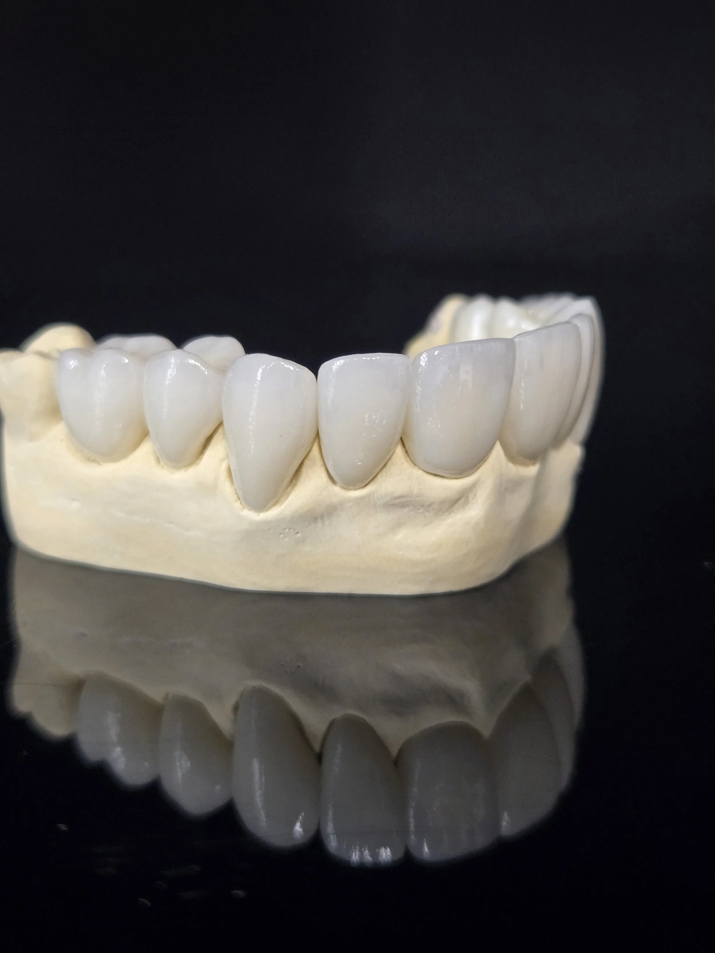 A dental model of a Porcelain Layered e.Max Crown, showing the upper set of teeth with a slight reflection on the black surface.