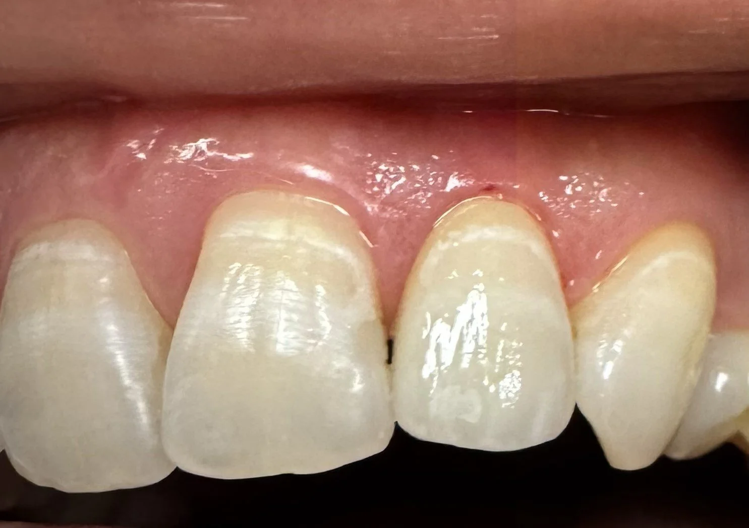 Anterior_Full_Contour_e.Max_Crown.jpeg