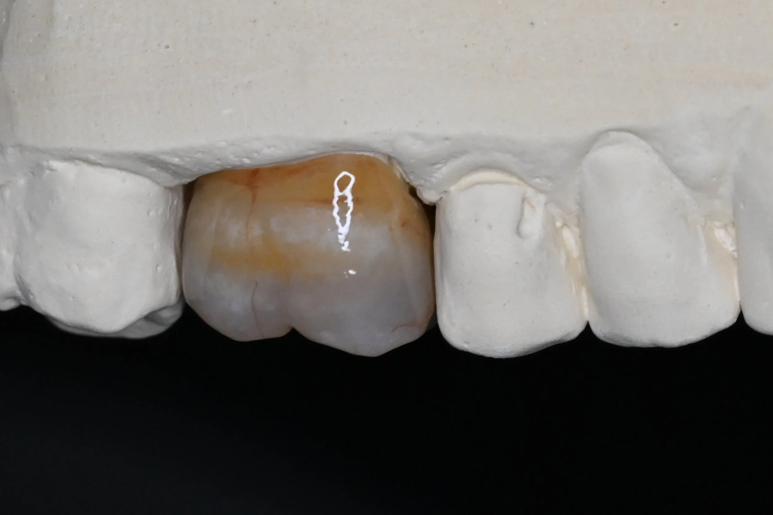 Full Contour Super Translucent Zirconia Crown