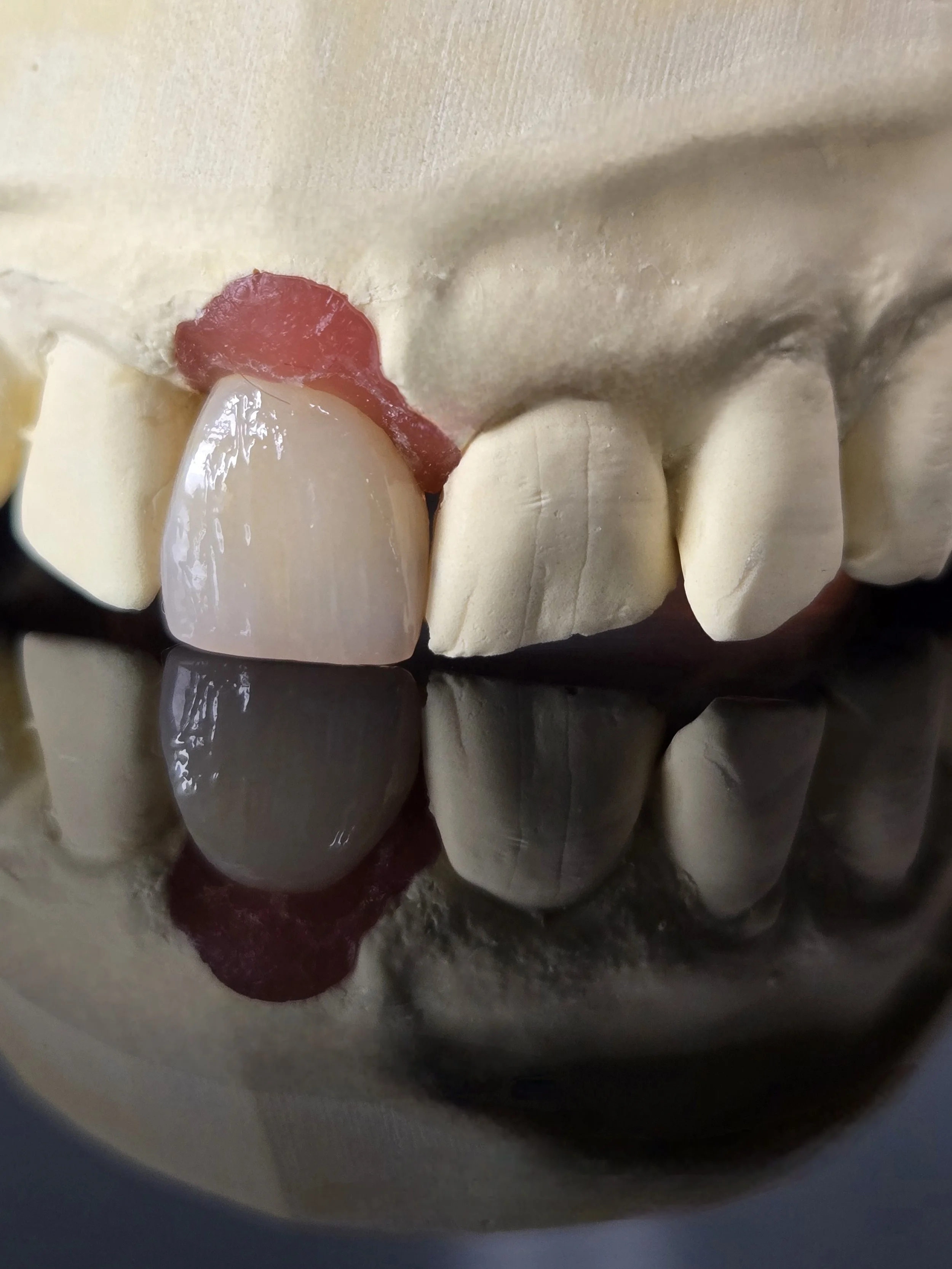 Dental model showing a tooth with a red material applied to it.