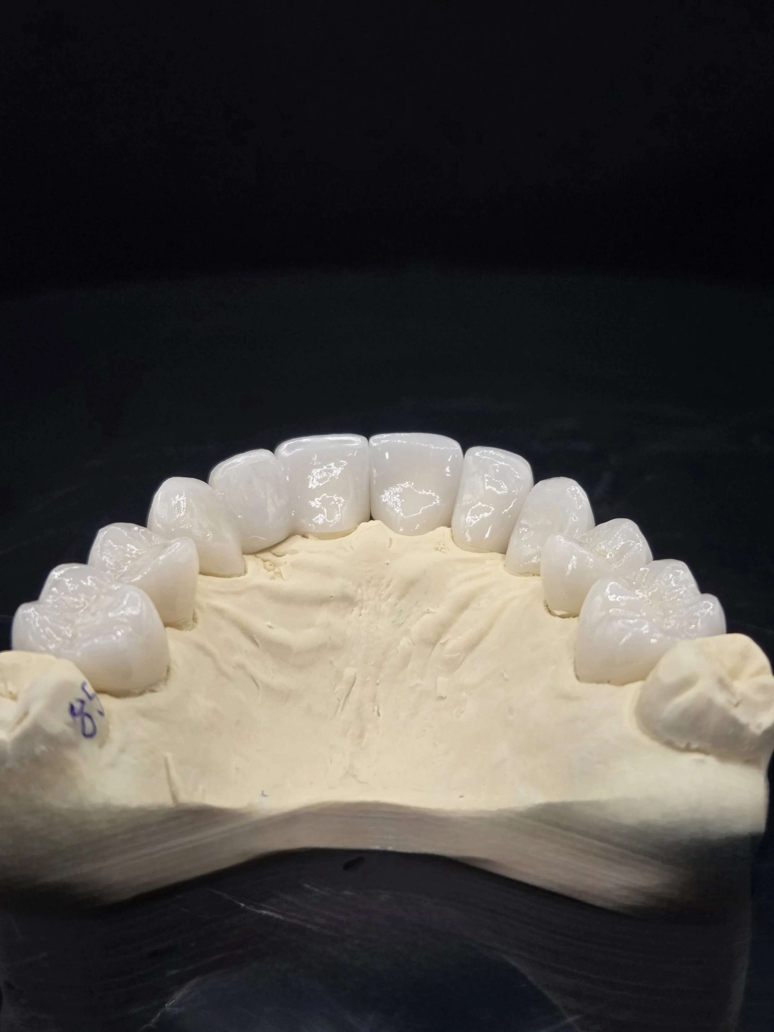 Anterior_Layered_e.Max_Full_Coverage_Crowns_Lingual_View.jpg