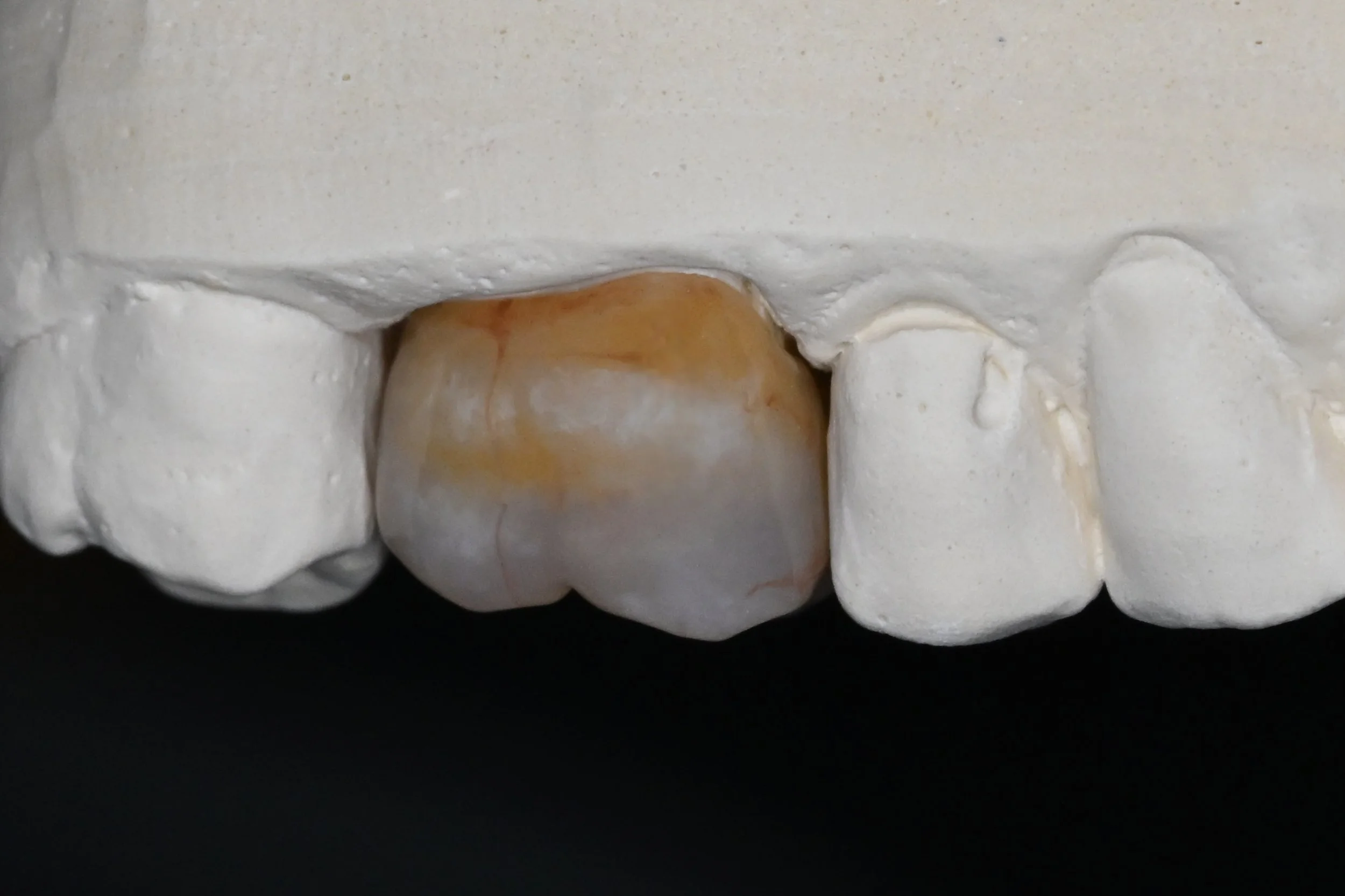 Posterior_Zirconia_Crown_With_Model_2.jpg