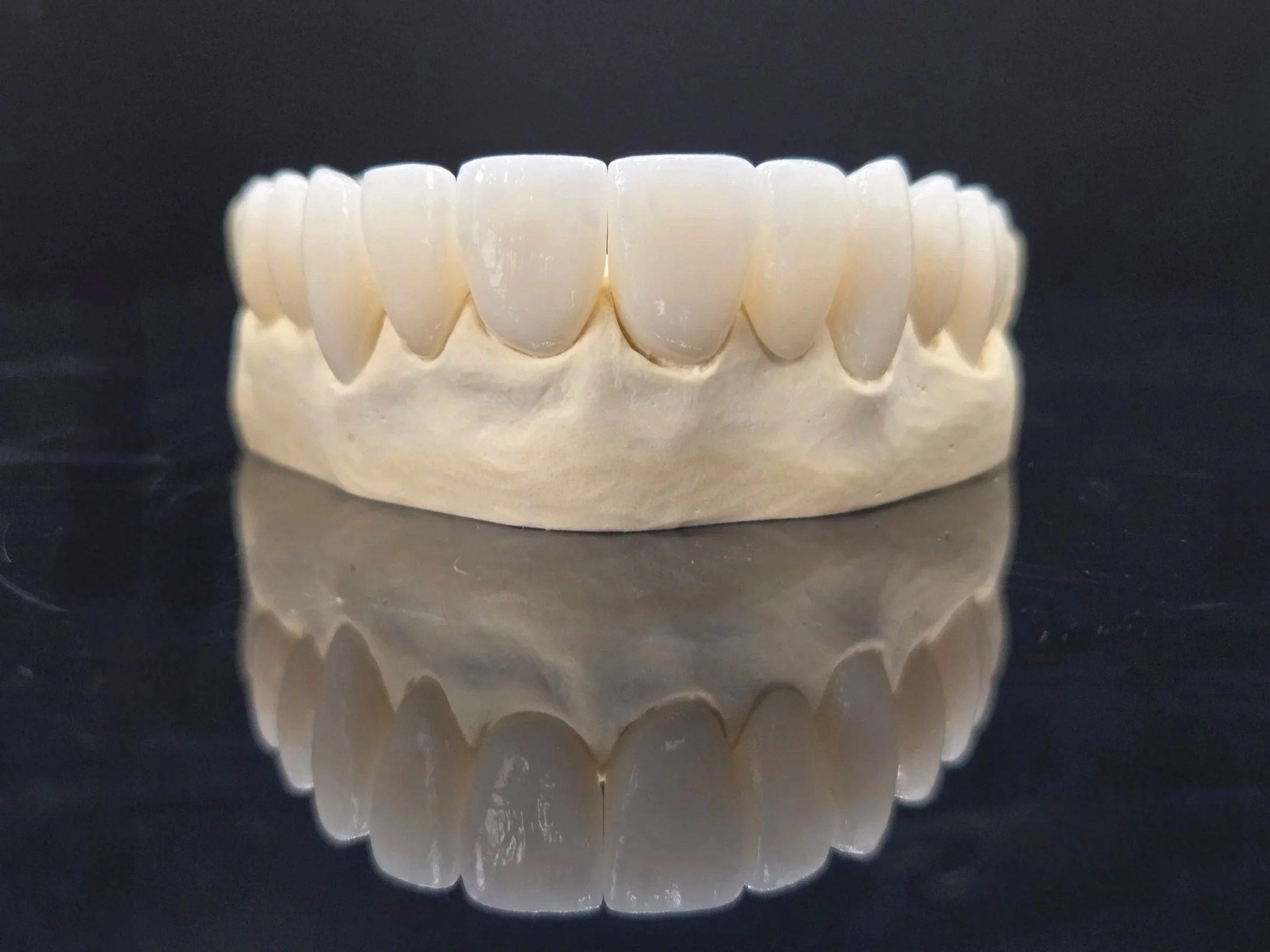 Porcelain Layered e.Max Crown