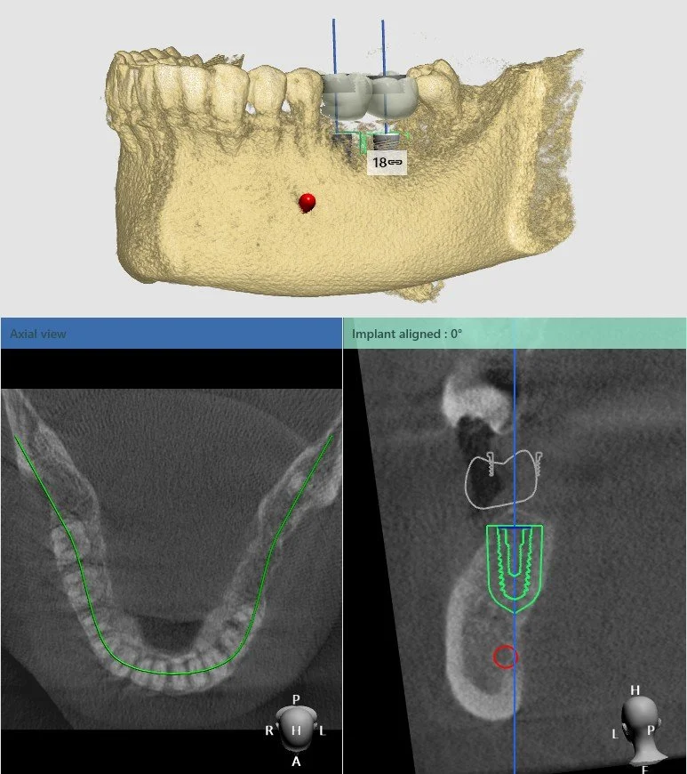 Fully Guided Surgical Guide