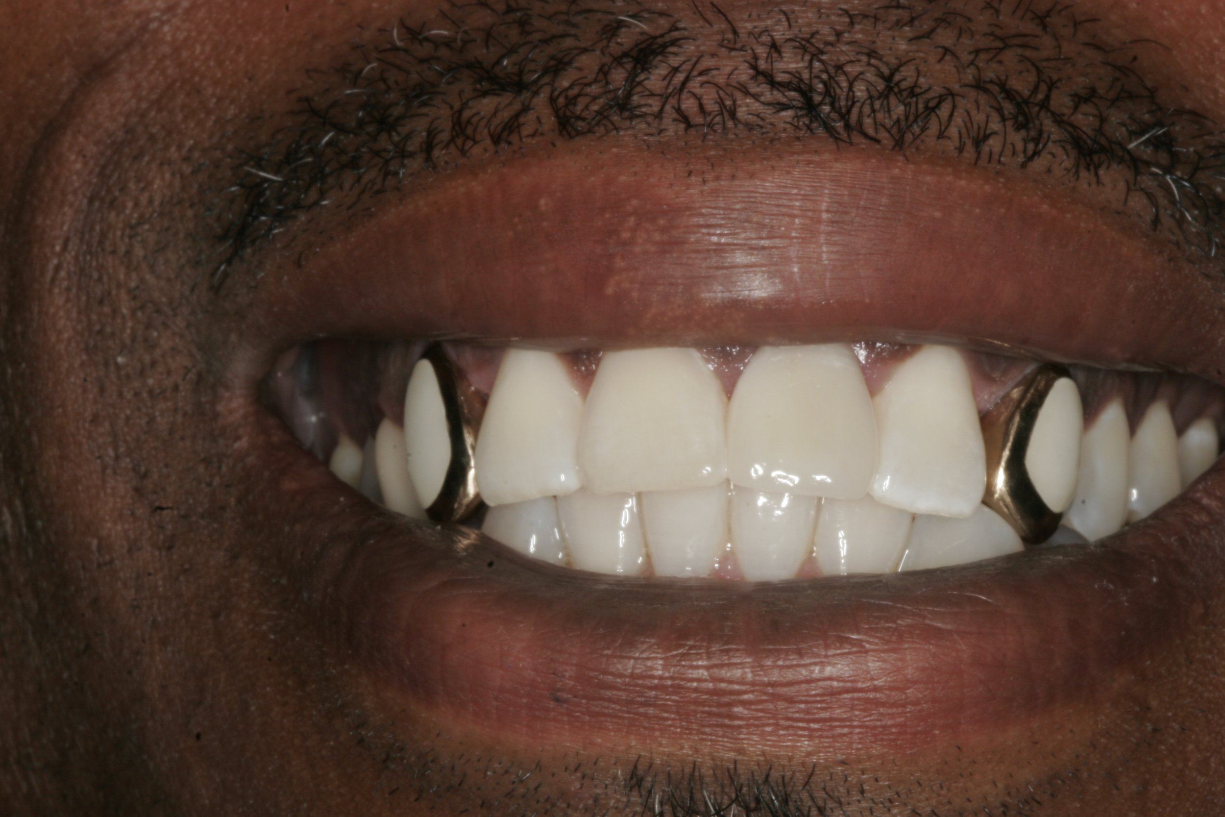 Gold_Window_Veneers_Front_View.jpg