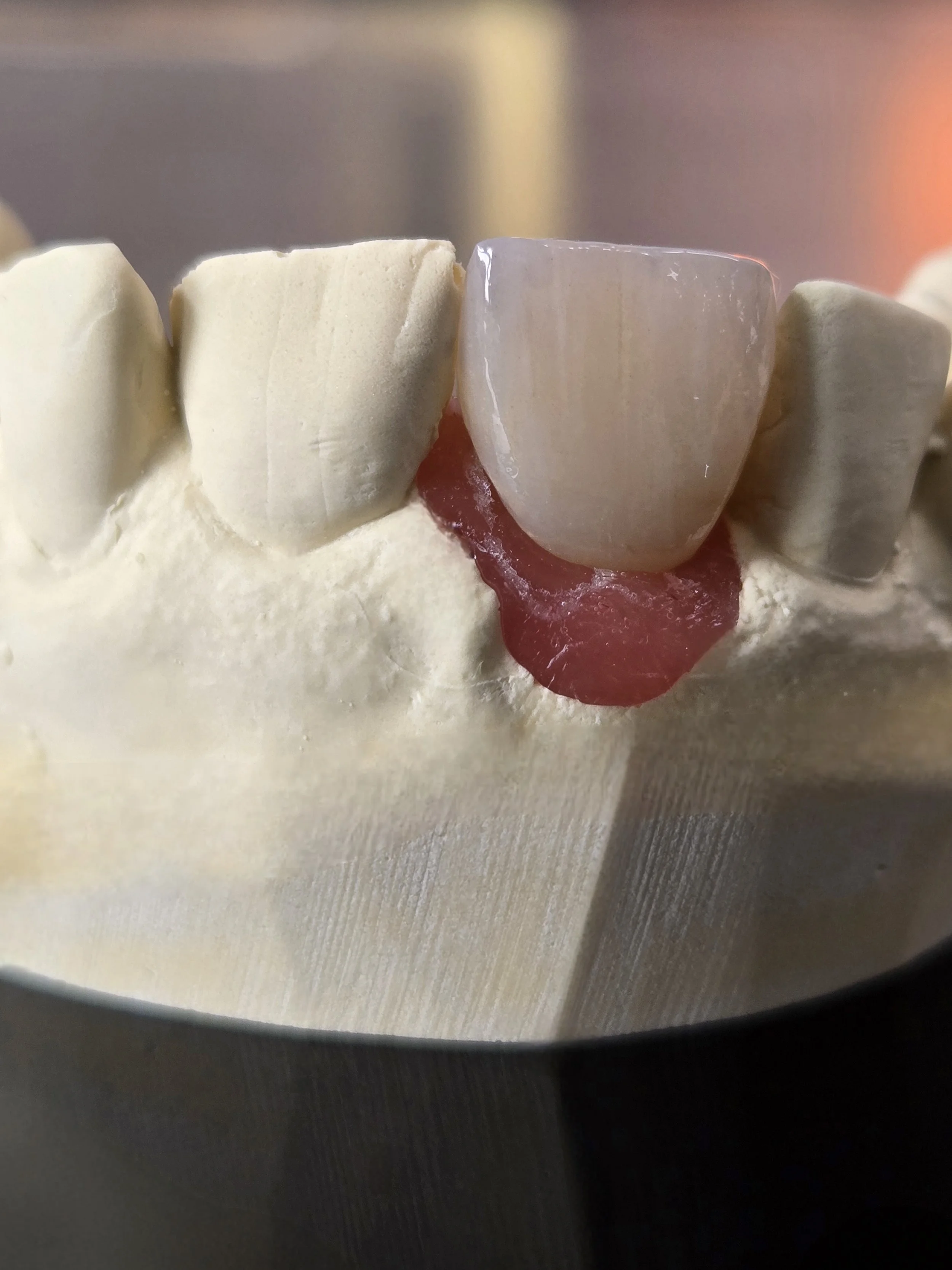 Nobel_Anterior_Layered_Zirconia_Angulated_Implant_Crown_3.jpg
