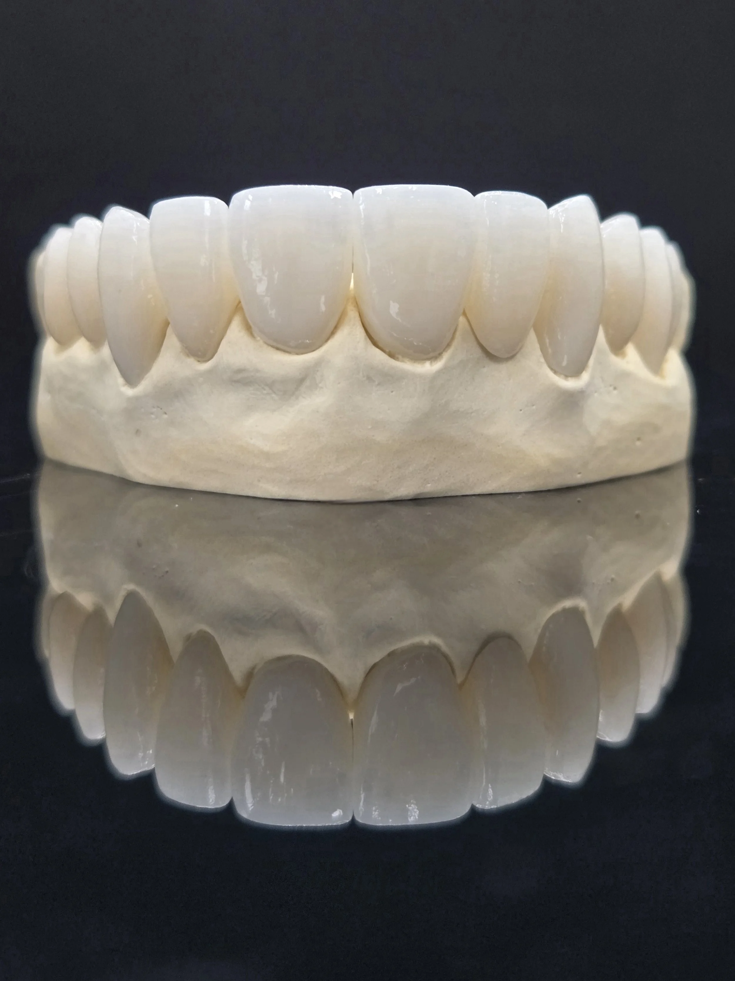 Anterior_Layered_e.Max_Full_Coverage_Crowns_Front_View_1.jpg