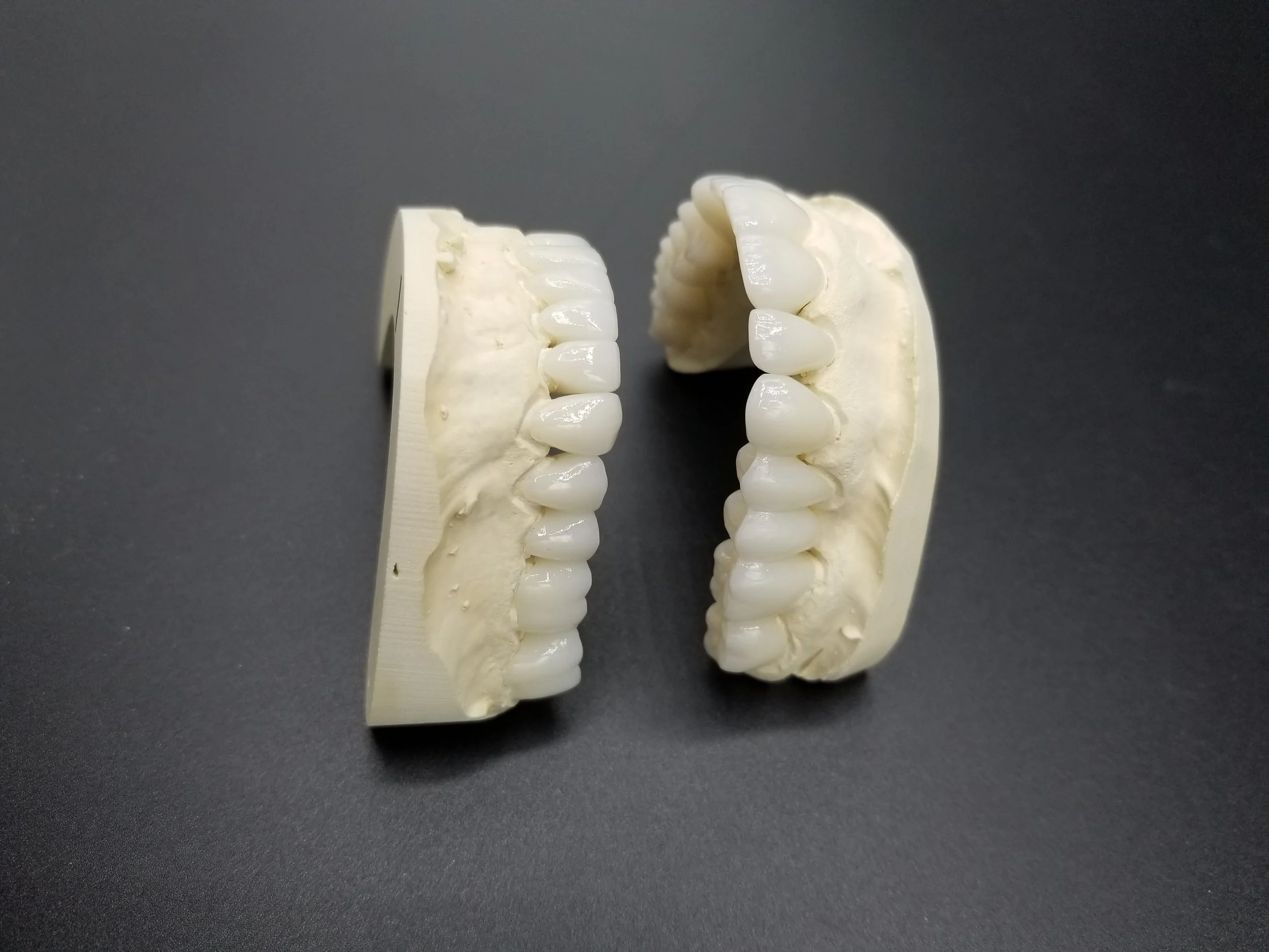 Full_Mouth_Rehabilitation_e.Max_Crowns_&_Veneers_2.JPG