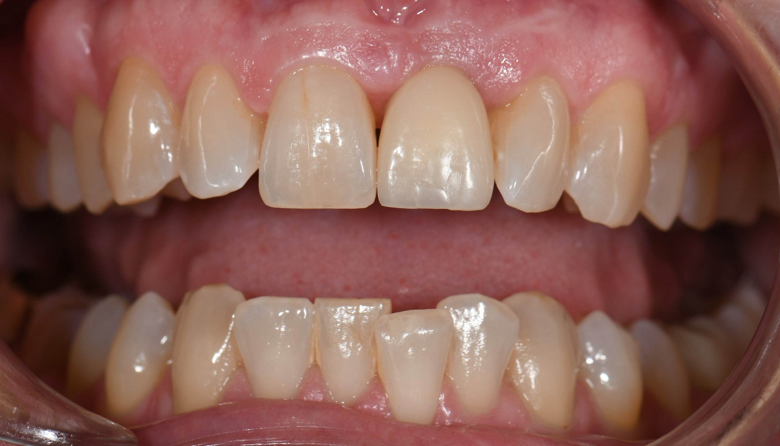 Temporary Implant #9.JPG