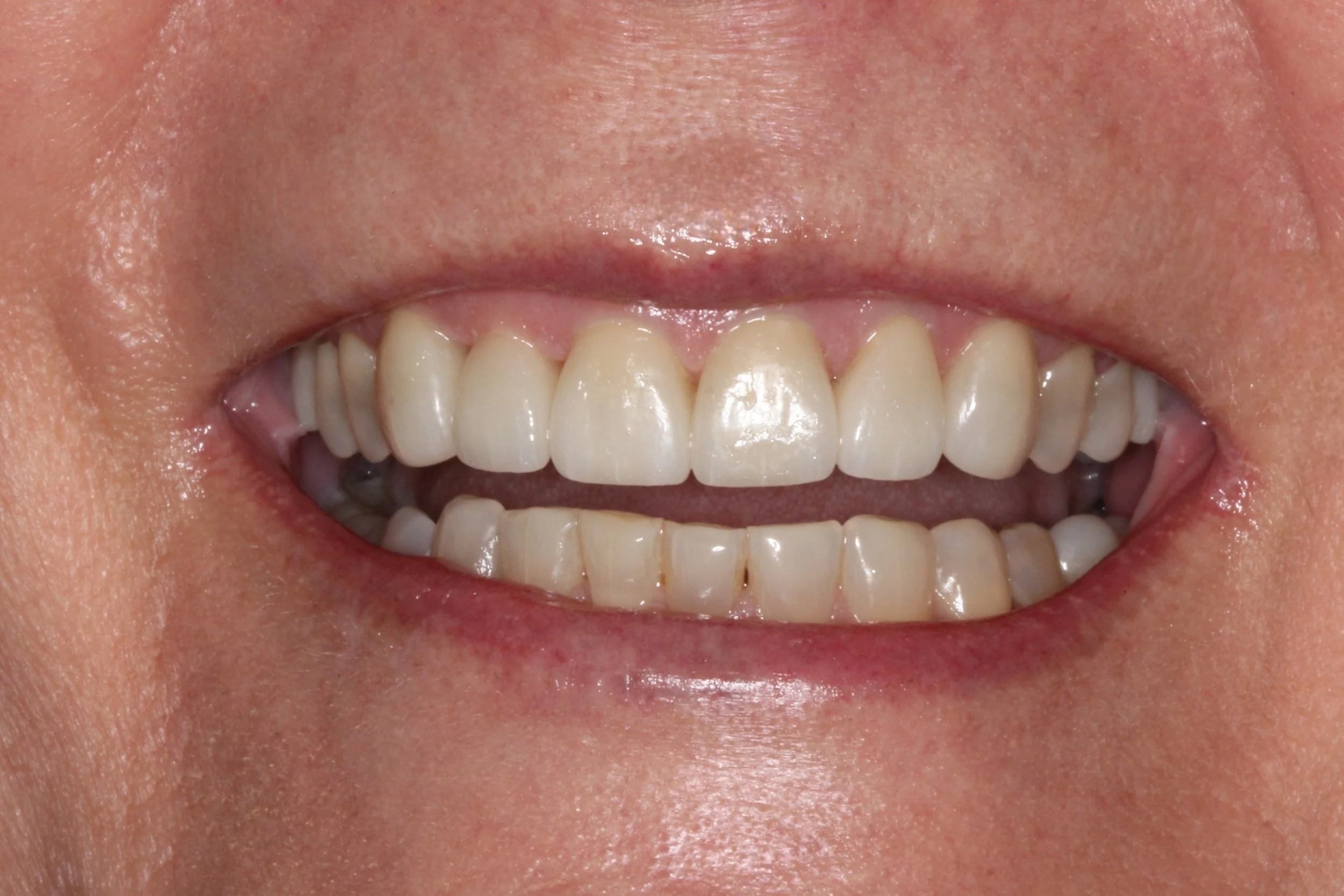 Anterior_Full_Coverage_e.Max_Natural_Smile_Open.jpg