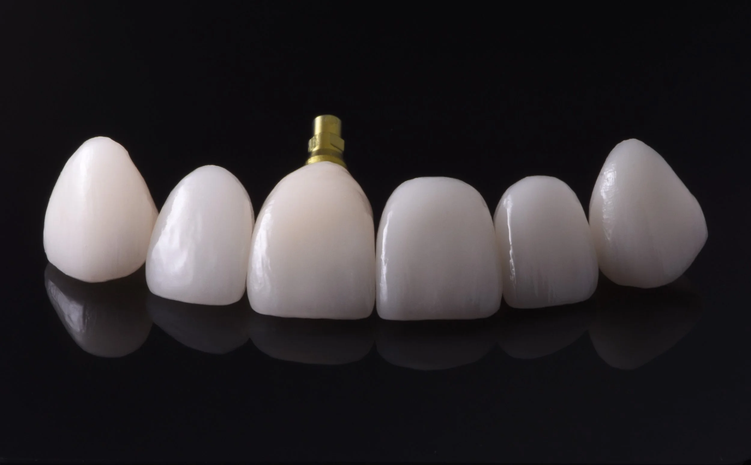 Mixed_Anterior_Layered_e.Max.jpg