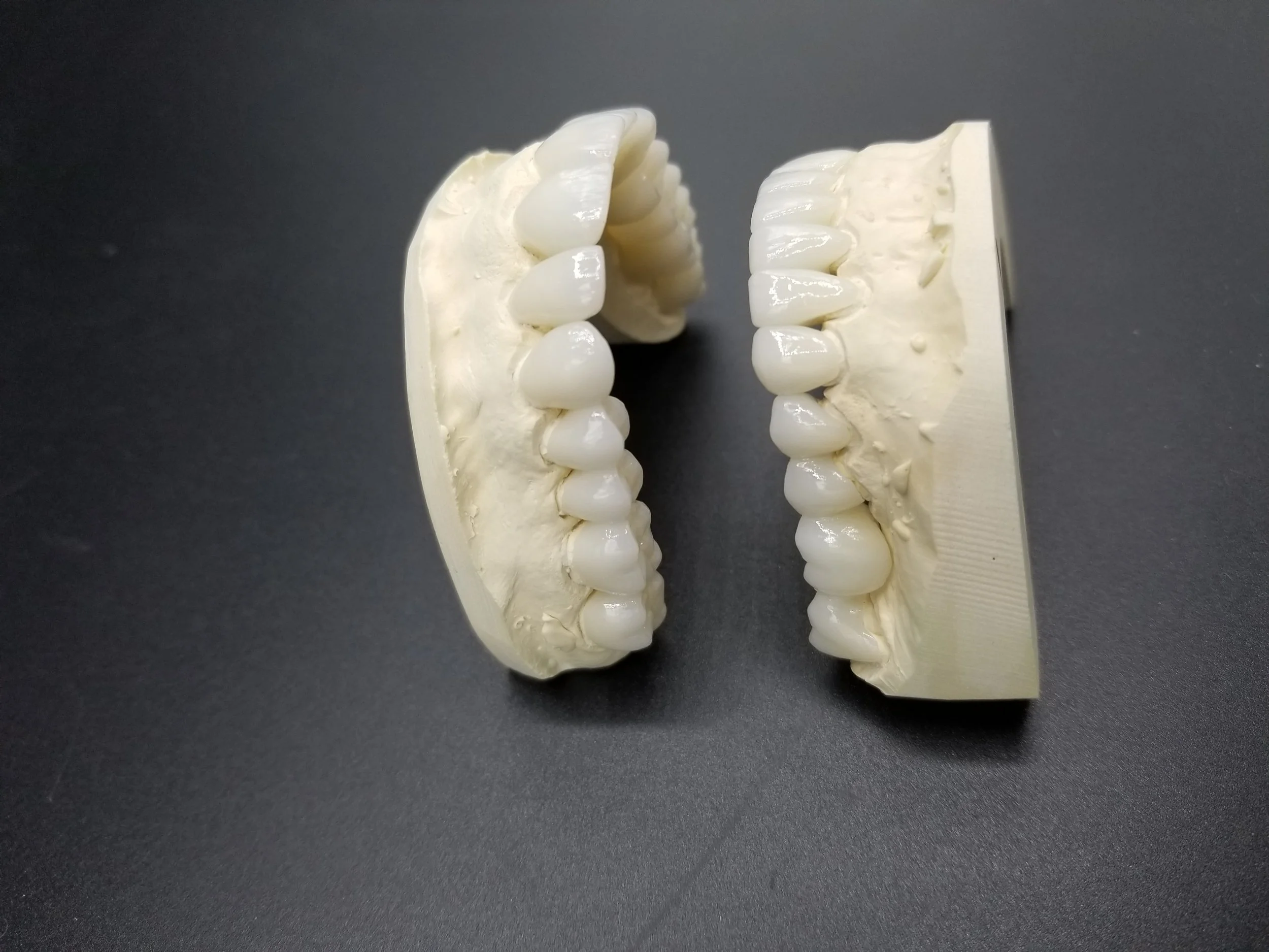 Full_Mouth_Rehabilitation_e.Max_Crowns_&_Veneers_3.jpg
