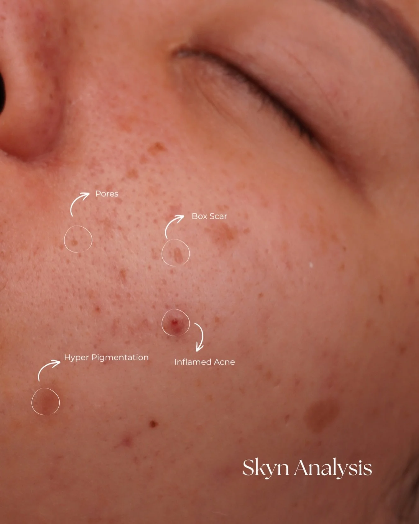 This skin analysis highlights multiple concerns occurring at once

&bull; Enlarged pores from excess oil and congestion
&bull; Hyperpigmentation caused by past breakouts and inflammation
&bull; Inflamed acne indicating an active skin barrier imbalanc