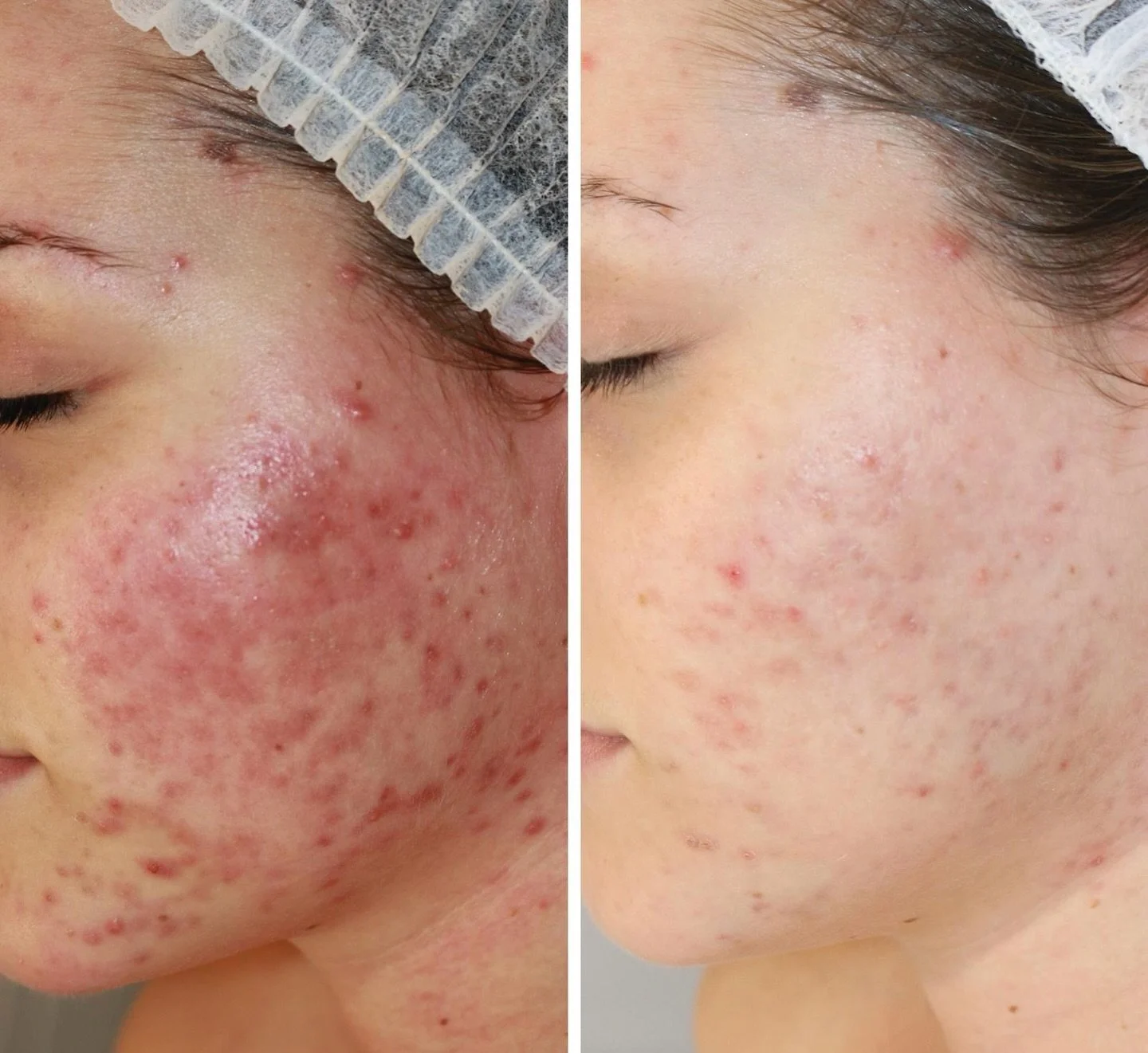 The power of a DMK treatment plan. Wether it&rsquo;s Acne, congestion or pigmentation and wrinkles. The DMK range is effective to treat all skin concerns all while supporting your internal and external health. 

No unecesary treatments no filler ingr
